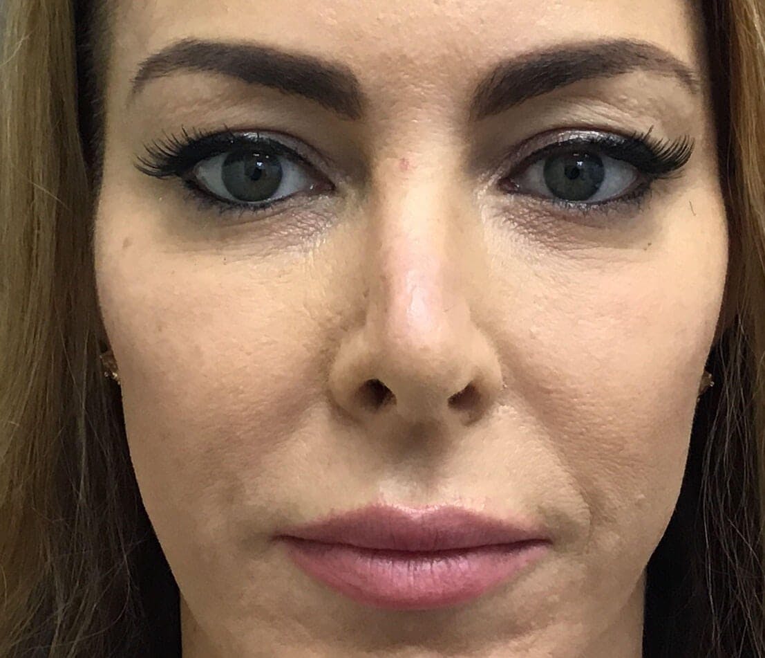 Eyelid Surgery Before & After Gallery - Patient 328728 - Image 1