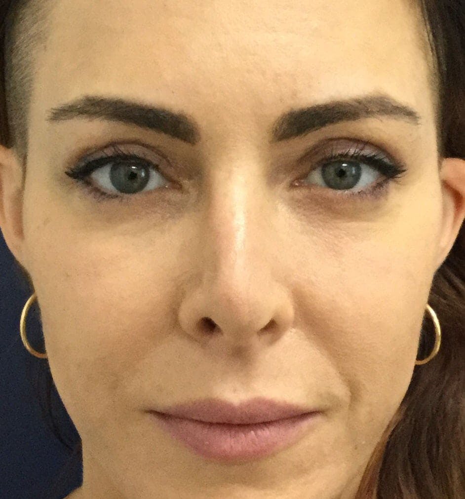 Eyelid Surgery Before & After Gallery - Patient 328728 - Image 2