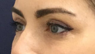 Eyelid Surgery Before & After Gallery - Patient 328728 - Image 4