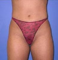 Liposuction Before & After Gallery - Patient 656983 - Image 2