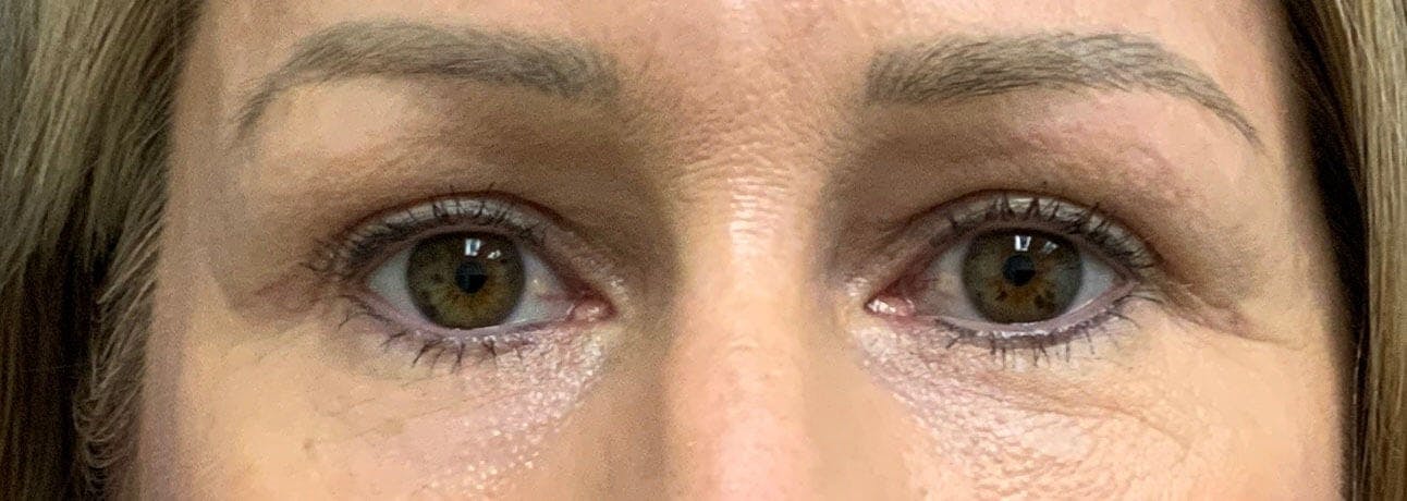 Eyelid Surgery Before & After Gallery - Patient 116715 - Image 2