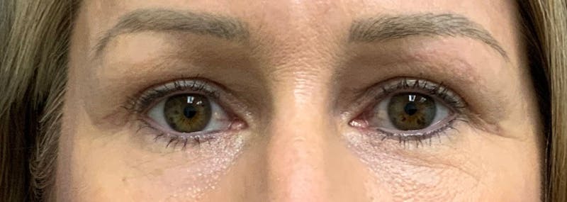 Eyelid Surgery Before & After Gallery - Patient 116715 - Image 2