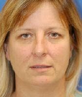 Brow Lift Before & After Gallery - Patient 349560 - Image 1