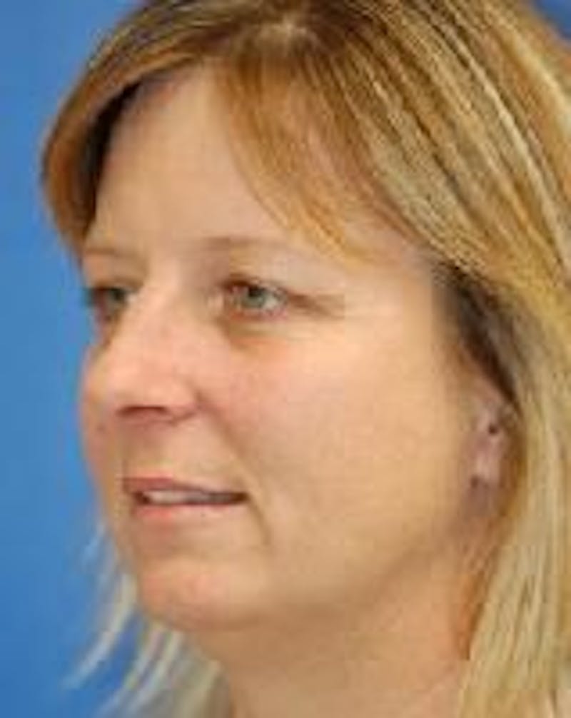 Brow Lift Before & After Gallery - Patient 349560 - Image 3