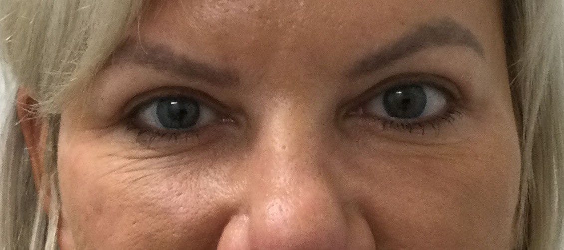 Eyelid Surgery Before & After Gallery - Patient 170175 - Image 2