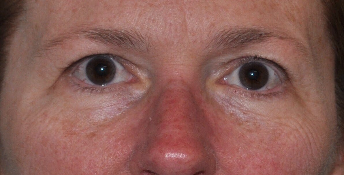 Eyelid Surgery Before & After Gallery - Patient 571958 - Image 1
