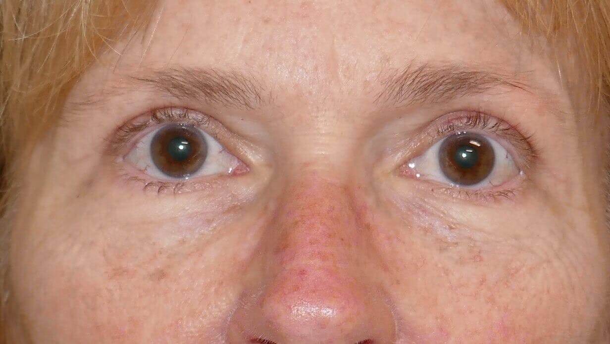 Eyelid Surgery Before & After Gallery - Patient 571958 - Image 2