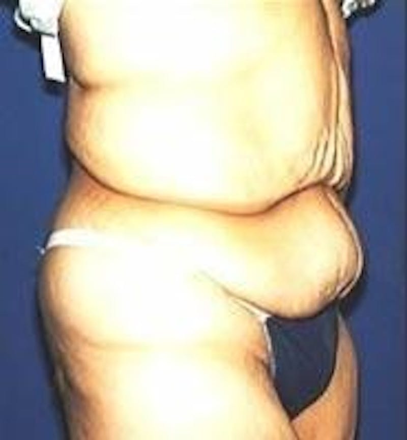 Tummy Tuck Before & After Gallery - Patient 230258 - Image 1