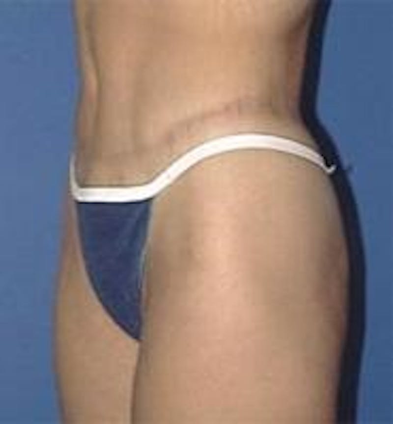 Tummy Tuck Before & After Gallery - Patient 230258 - Image 4