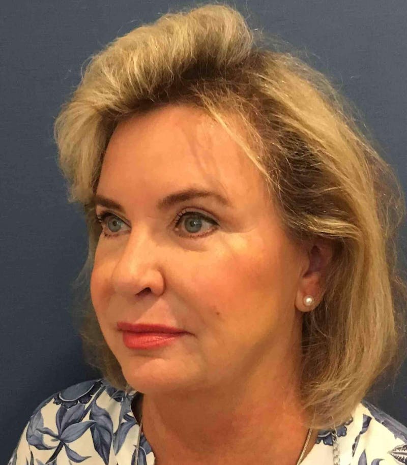 Eyelid Surgery Before & After Gallery - Patient 401595 - Image 4