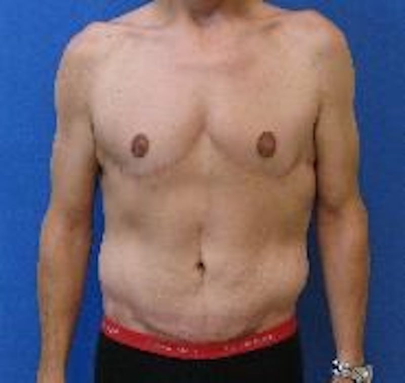 Tummy Tuck Before & After Gallery - Patient 350828 - Image 4