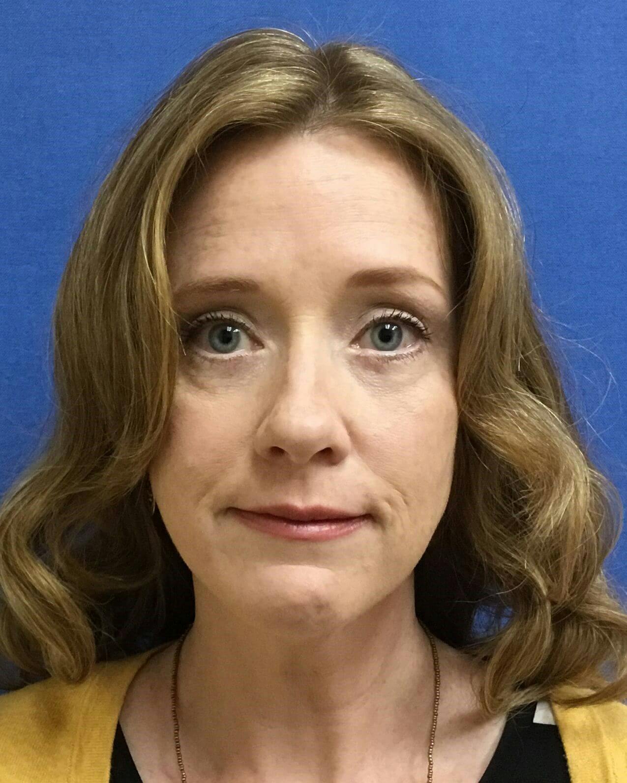 Eyelid Surgery Before & After Gallery - Patient 238091 - Image 2