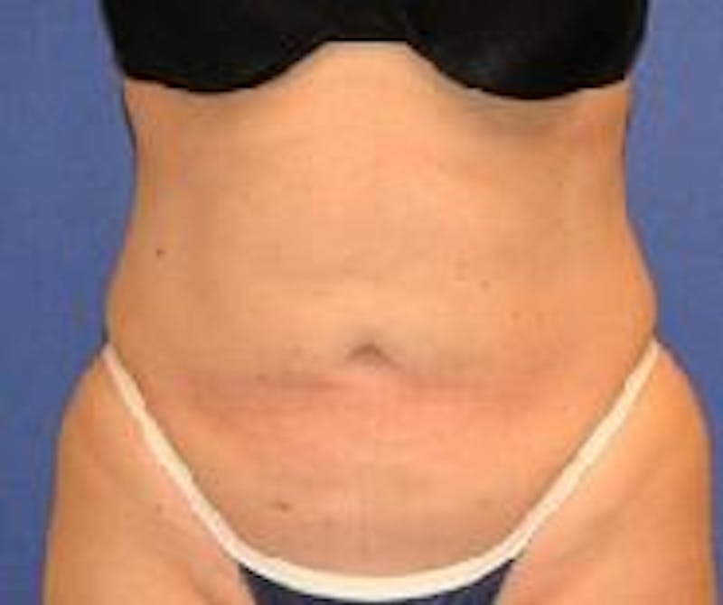 Liposuction Before & After Gallery - Patient 132558 - Image 2