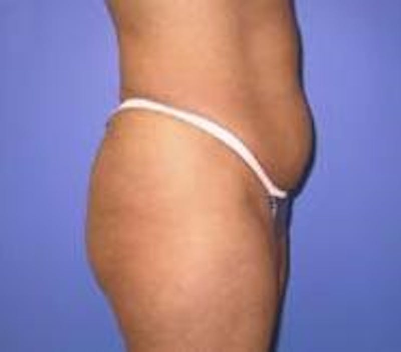 Tummy Tuck Before & After Gallery - Patient 818401 - Image 3