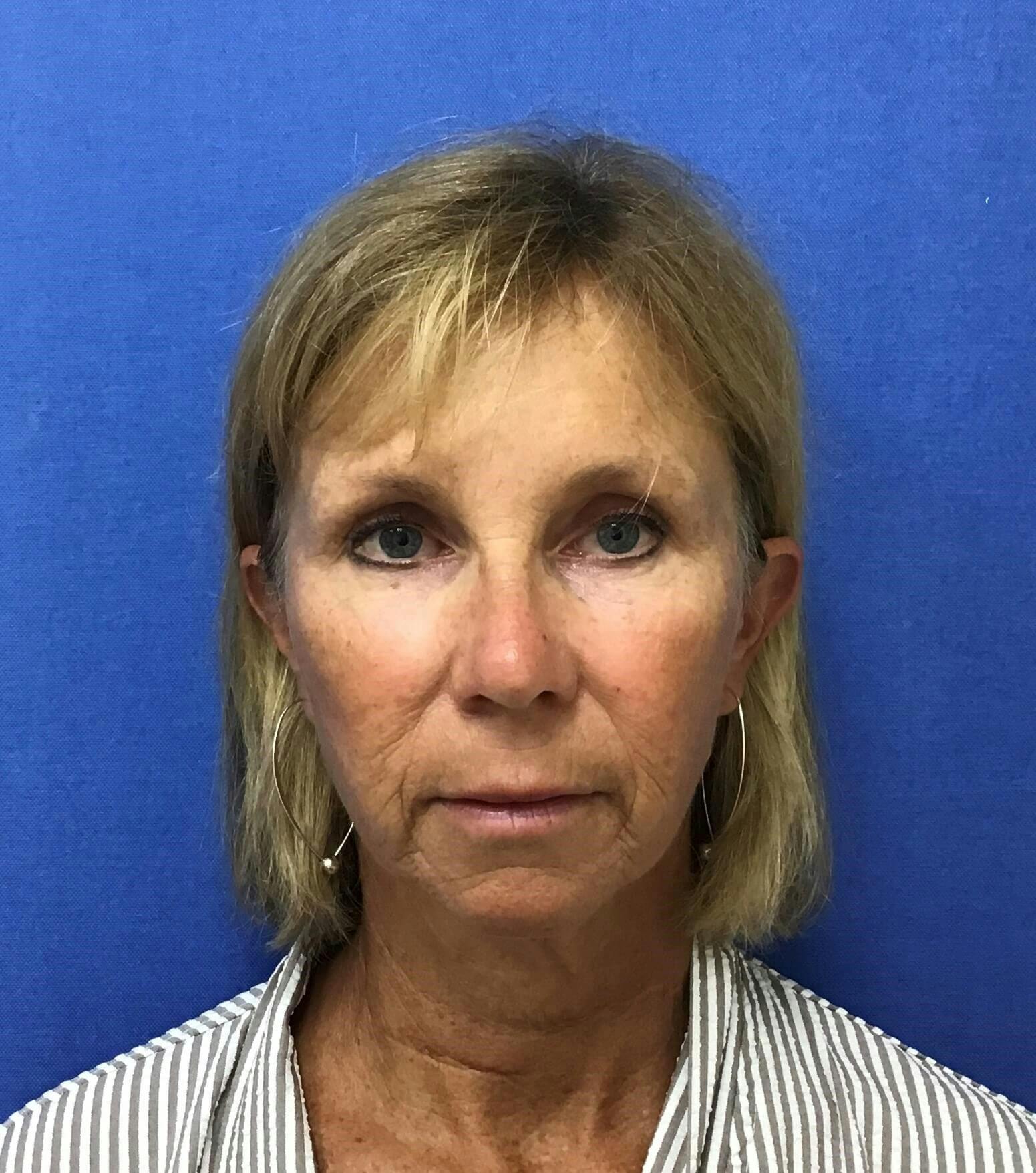 Face Lift Before & After Gallery - Patient 260655 - Image 1