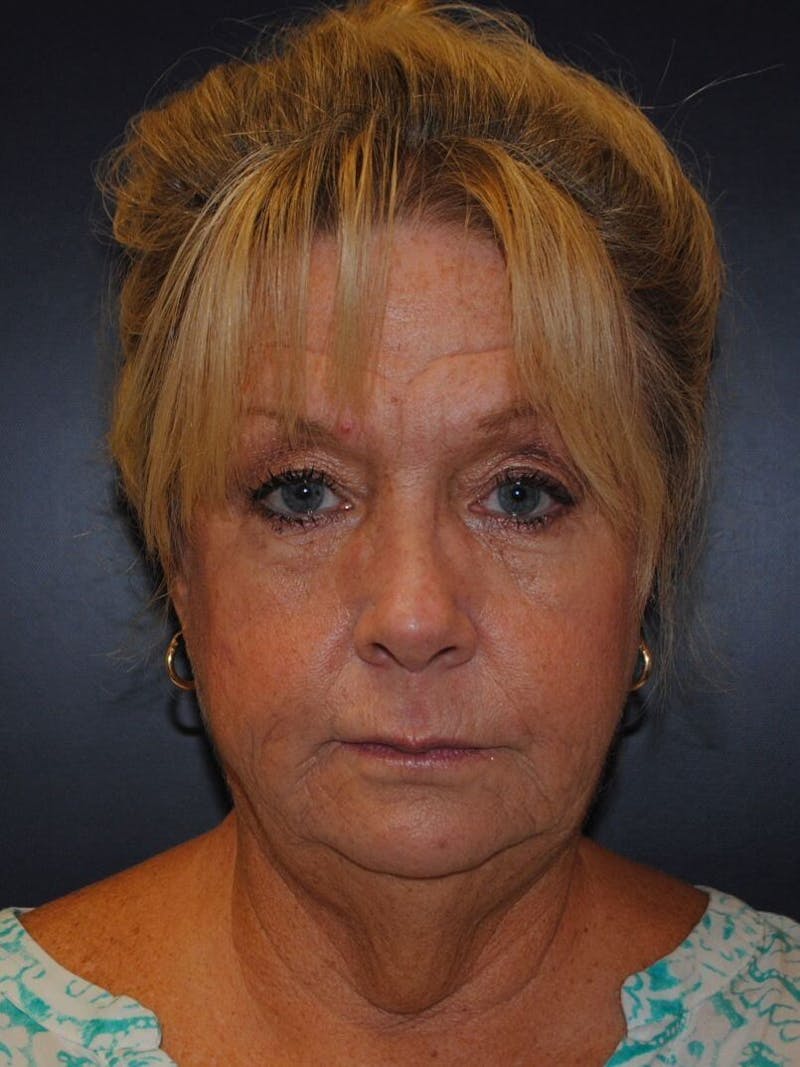 Neck Lift Before & After Gallery - Patient 389034 - Image 1