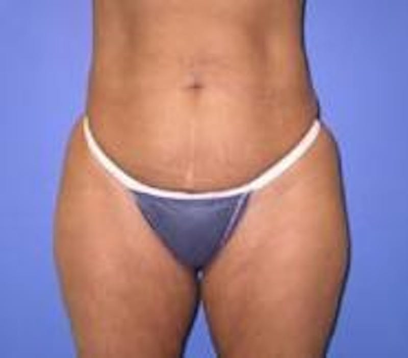 Tummy Tuck Before & After Gallery - Patient 818401 - Image 5