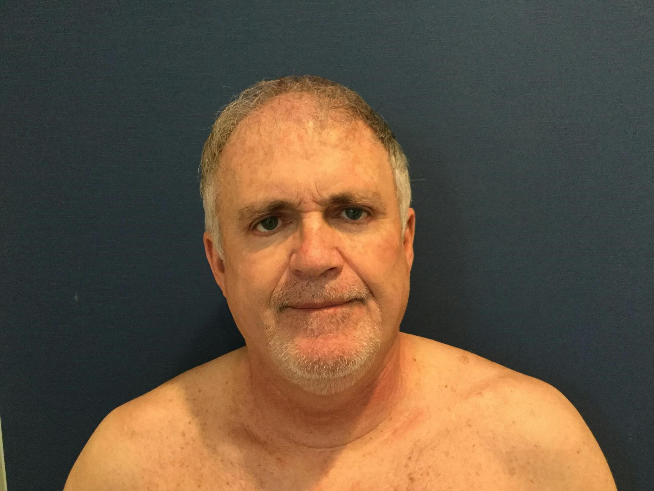 Eyelid Surgery Before & After Gallery - Patient 320321 - Image 2