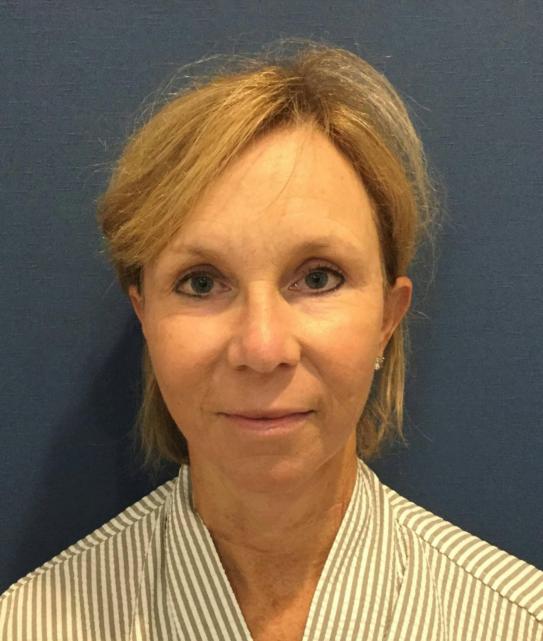 Face Lift Before & After Gallery - Patient 260655 - Image 2