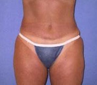Tummy Tuck Before & After Gallery - Patient 818401 - Image 6