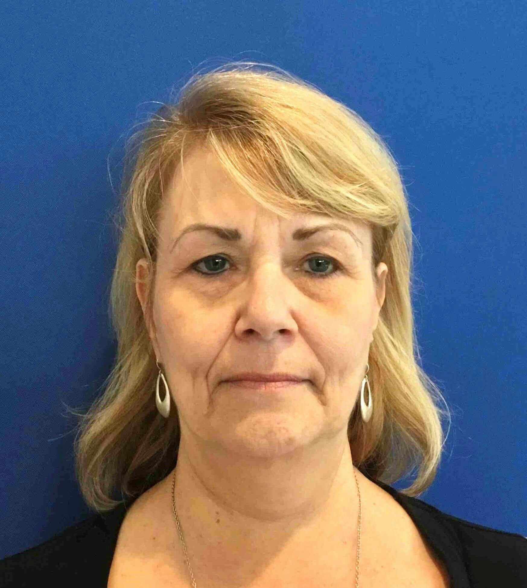 Face Lift Before & After Gallery - Patient 412898 - Image 1