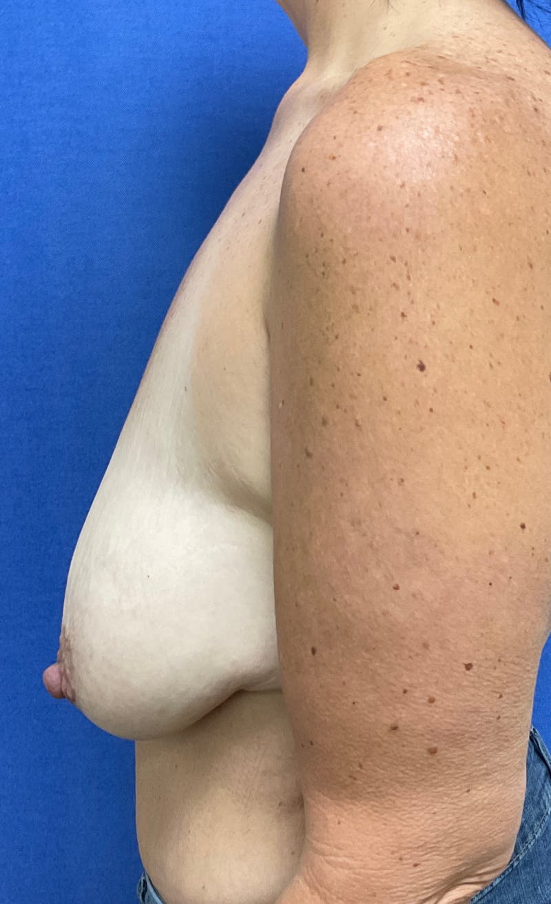 Dr. Chris Bates Before & After Gallery - Patient 209728 - Image 7