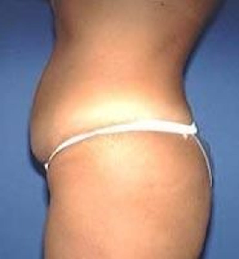 Tummy Tuck Before & After Gallery - Patient 186432 - Image 5