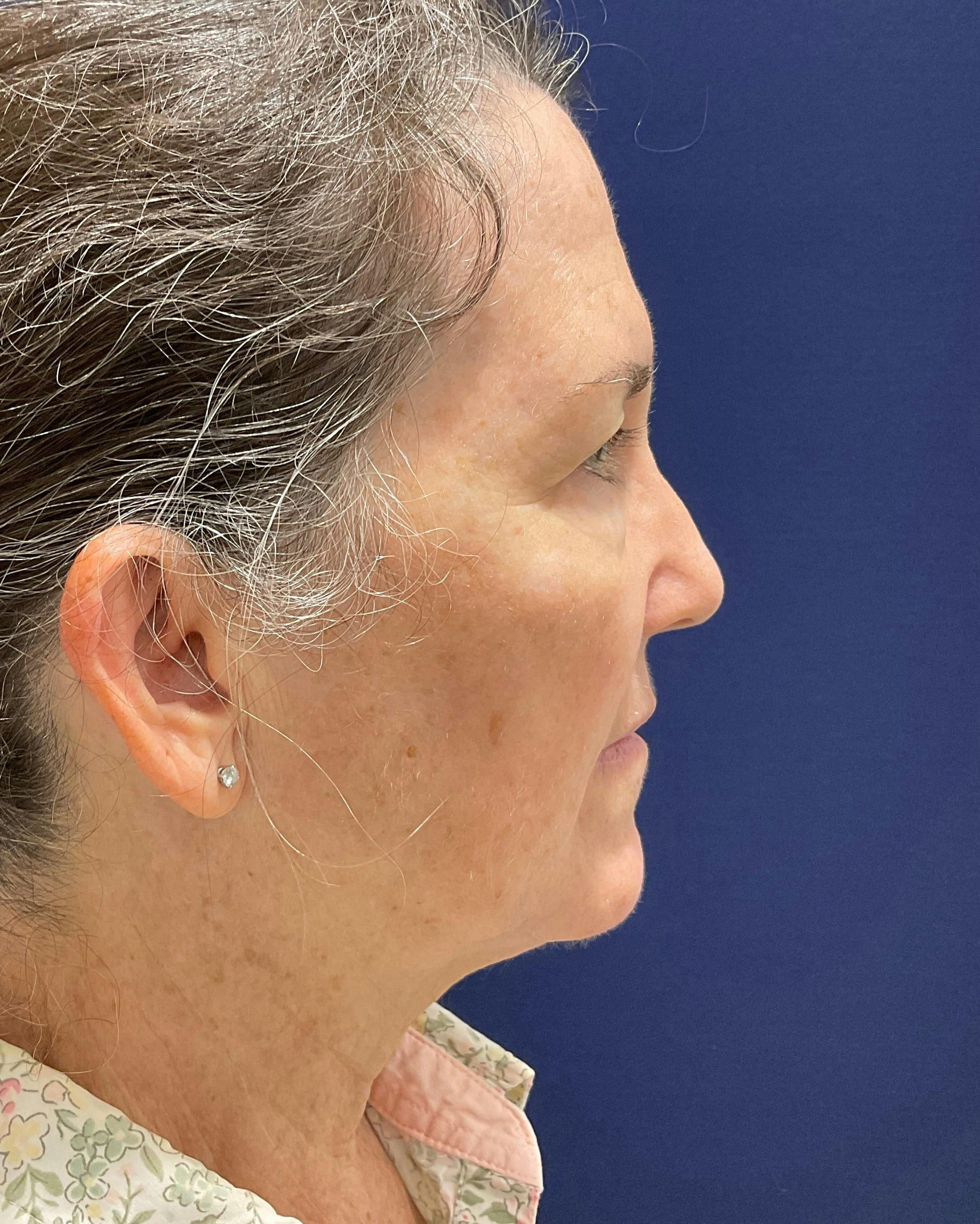 Rhinoplasty Before & After Gallery - Patient 917617 - Image 1