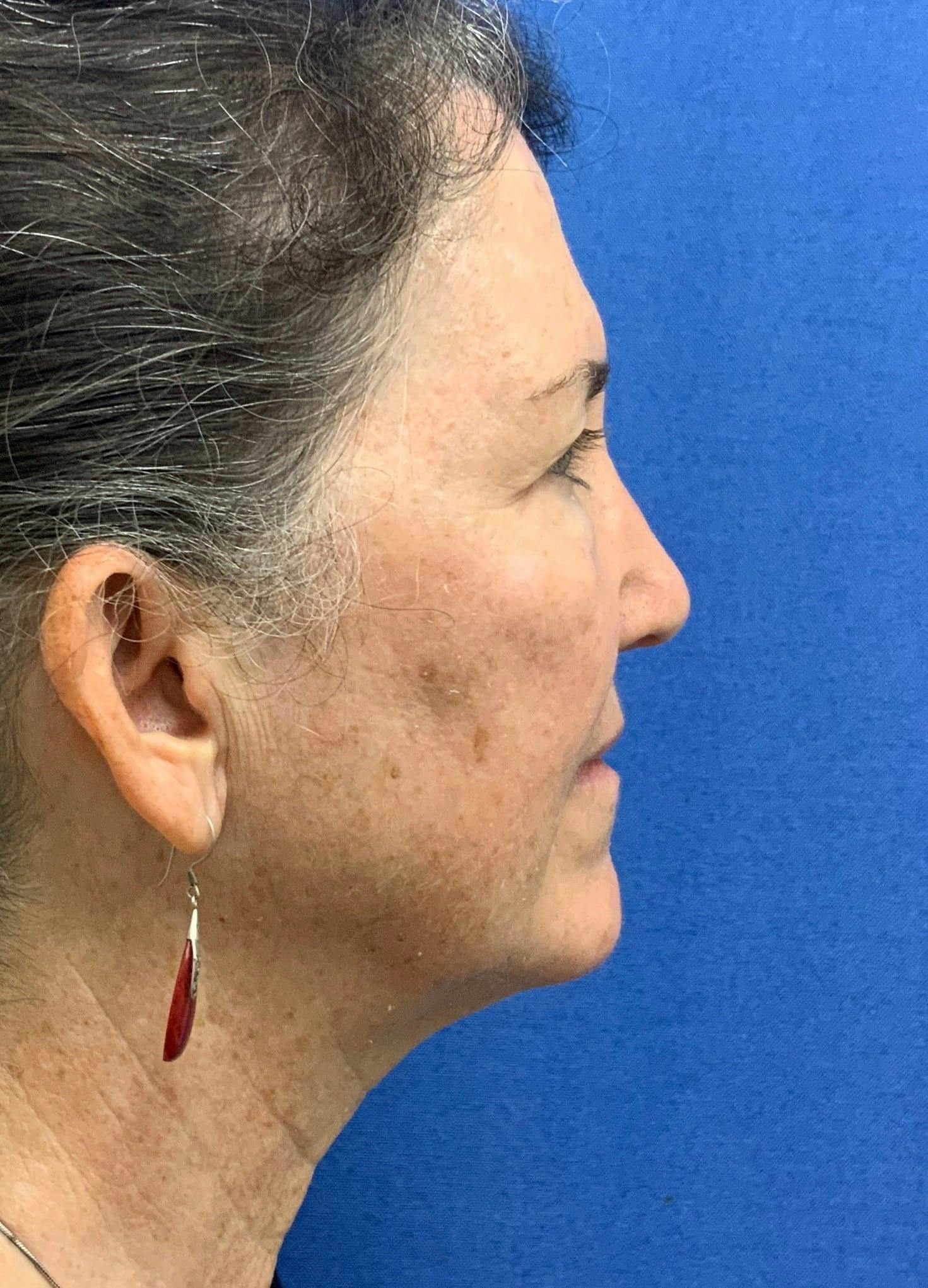 Rhinoplasty Before & After Gallery - Patient 917617 - Image 2