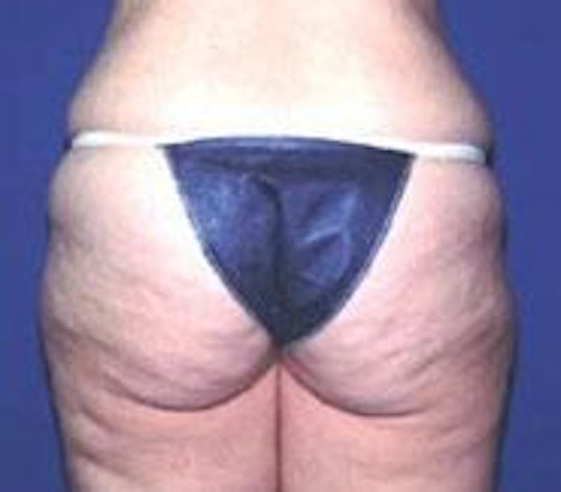 Tummy Tuck Before & After Gallery - Patient 700325 - Image 5