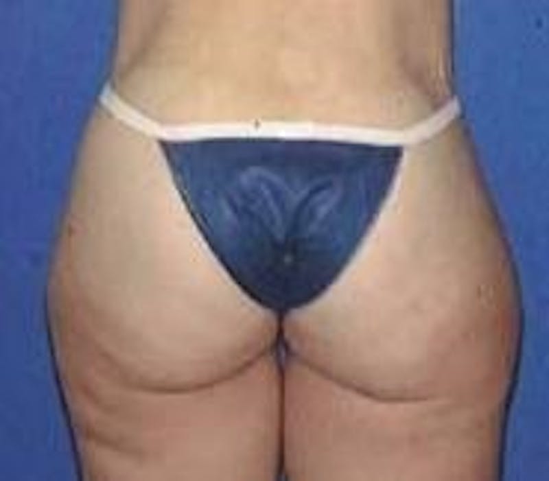 Tummy Tuck Before & After Gallery - Patient 700325 - Image 6