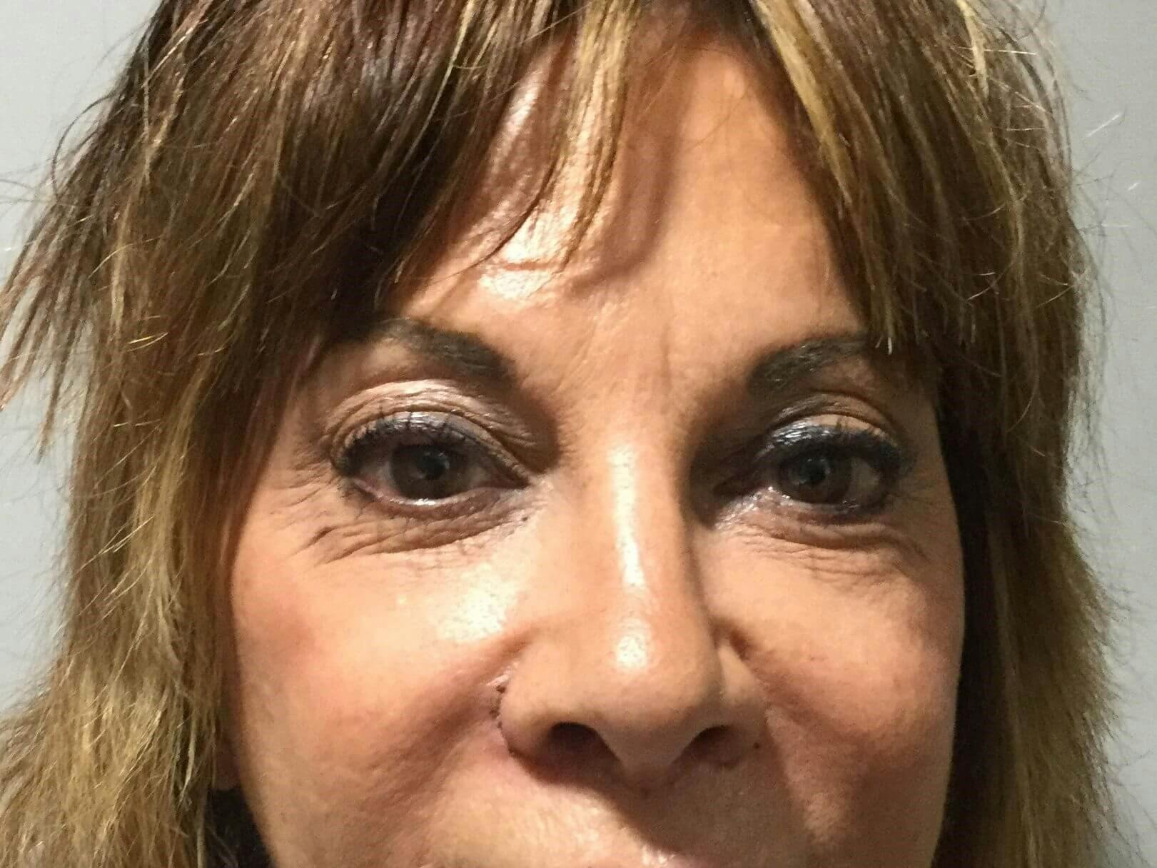 Eyelid Surgery Before & After Gallery - Patient 714126 - Image 1