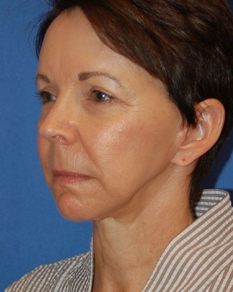 Neck Lift Before & After Gallery - Patient 649967 - Image 4