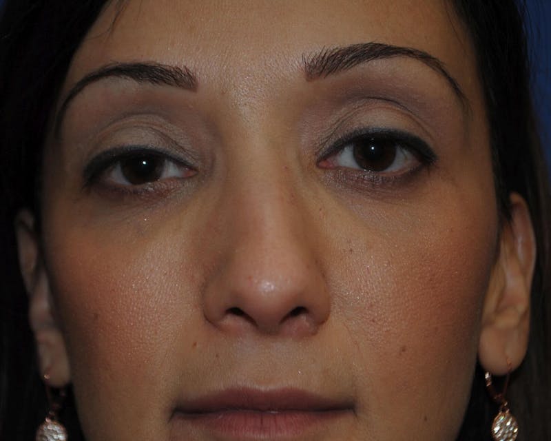Rhinoplasty Before & After Gallery - Patient 323019 - Image 5