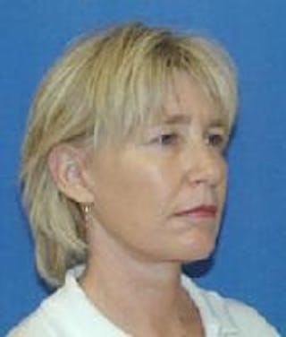 Face Lift Before & After Gallery - Patient 214026 - Image 4
