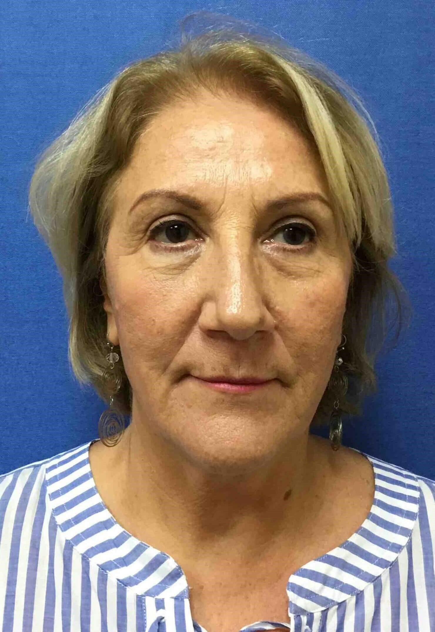 Eyelid Surgery Before & After Gallery - Patient 128393 - Image 2