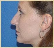 Rhinoplasty Before & After Gallery - Patient 420240 - Image 1