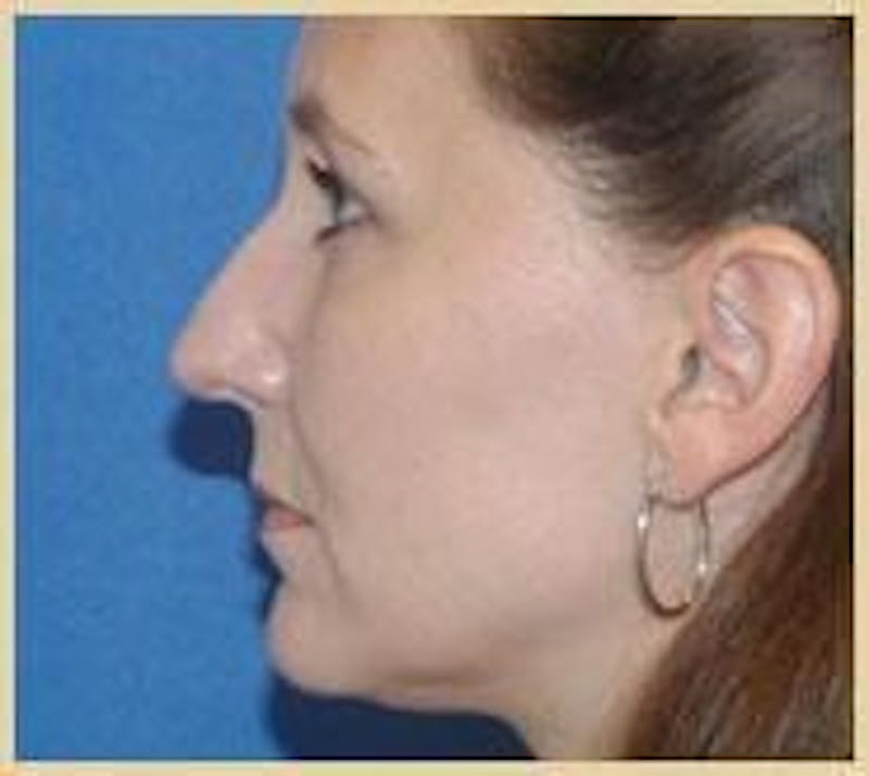 Rhinoplasty Before & After Gallery - Patient 420240 - Image 1