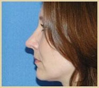 Rhinoplasty Before & After Gallery - Patient 420240 - Image 2