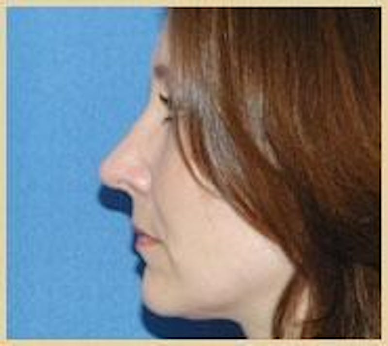 Rhinoplasty Before & After Gallery - Patient 420240 - Image 2