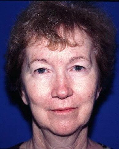 Face Lift Before & After Gallery - Patient 383926 - Image 1