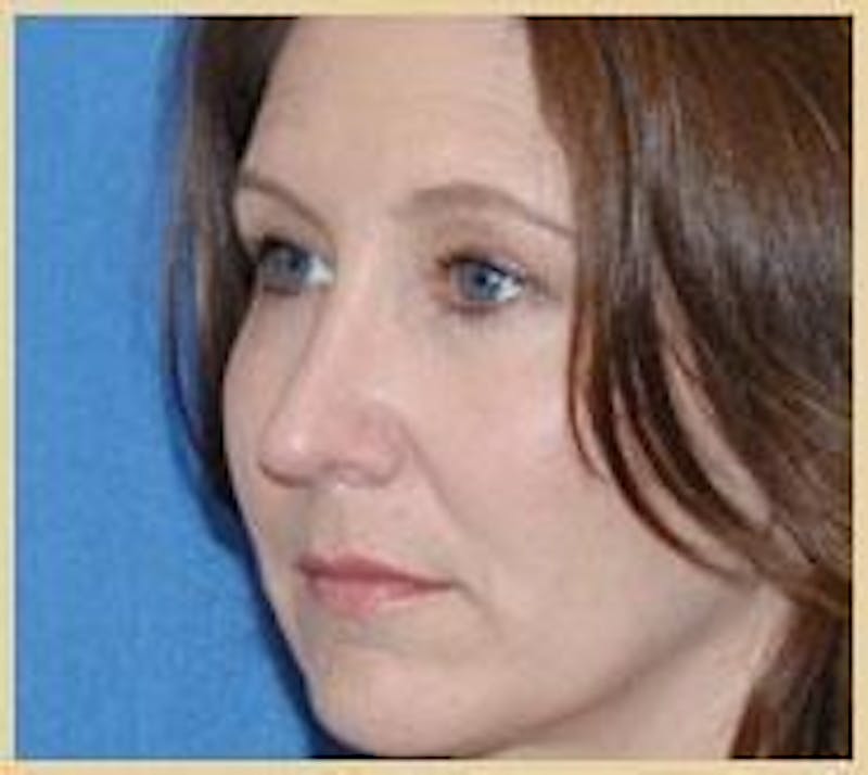 Rhinoplasty Before & After Gallery - Patient 420240 - Image 4