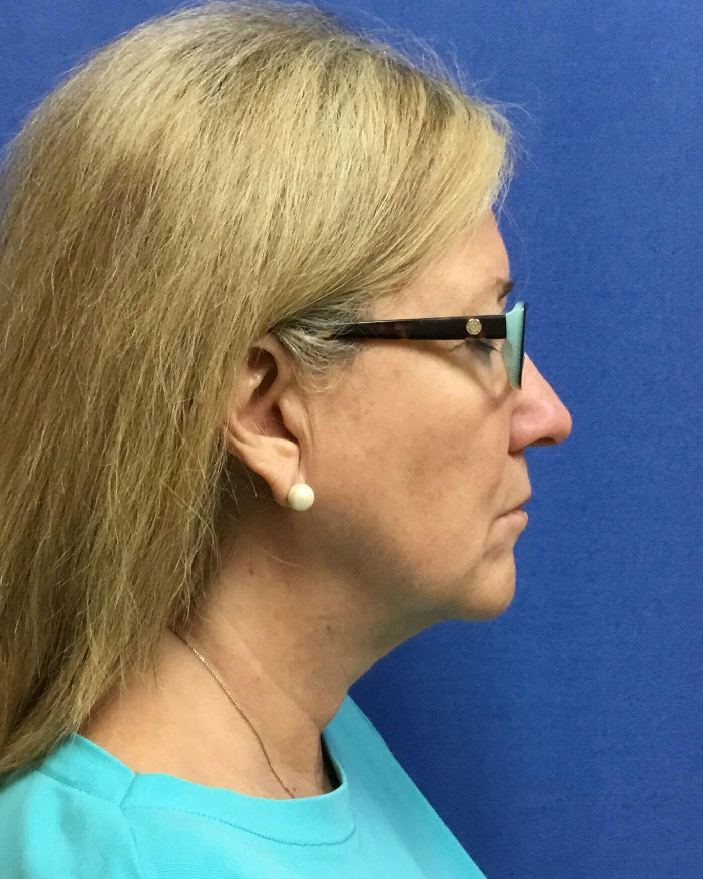 Neck Liposuction Before & After Gallery - Patient 272715 - Image 2