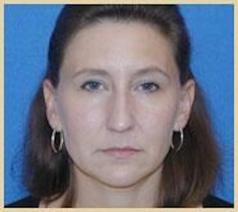 Rhinoplasty Before & After Gallery - Patient 420240 - Image 5