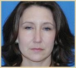 Rhinoplasty Before & After Gallery - Patient 420240 - Image 6