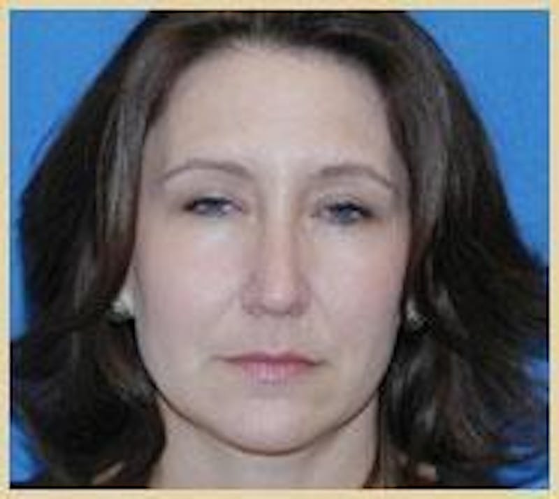Rhinoplasty Before & After Gallery - Patient 420240 - Image 6