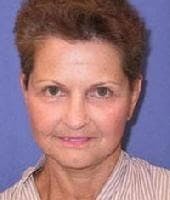 Neck Lift Before & After Gallery - Patient 308278 - Image 2