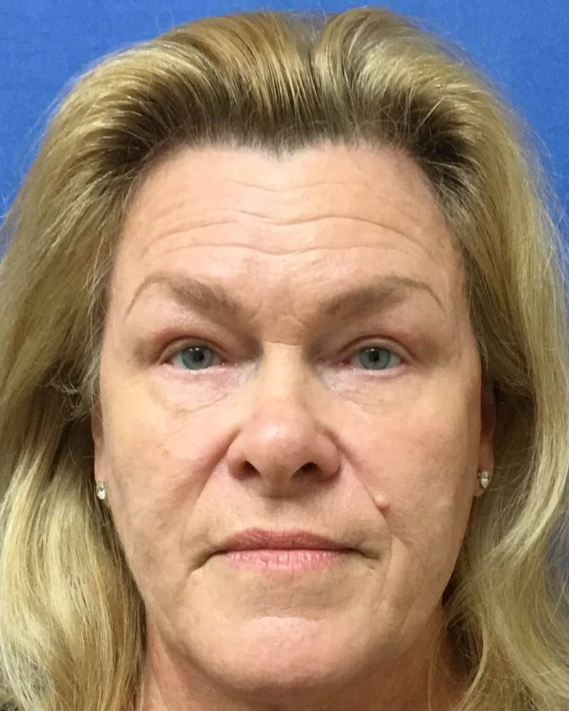 Eyelid Surgery Before & After Gallery - Patient 129146 - Image 2