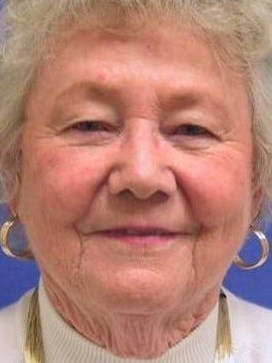 Face Lift Before & After Gallery - Patient 331383 - Image 1