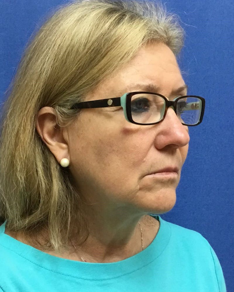 Neck Liposuction Before & After Gallery - Patient 272715 - Image 6